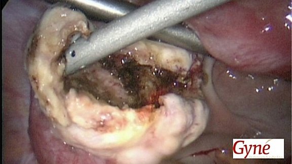 endometriom2.jpeg