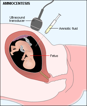 amniocentesis.gif 