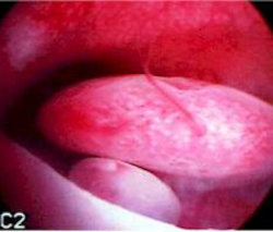 polyp.jpeg